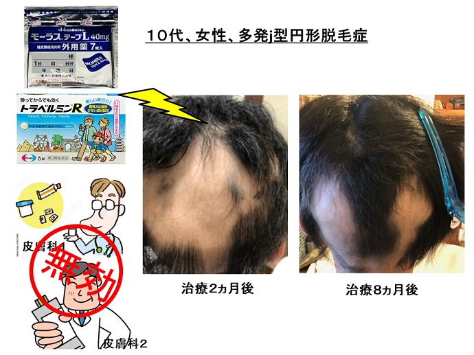 円形脱毛症　病院